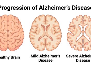 Alzheimer hastalığının ilerleme evrelerini gösteren üç beyin çizimi yer alıyor.