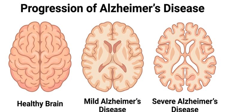 Alzheimer hastalığının ilerleme evrelerini gösteren üç beyin çizimi yer alıyor.